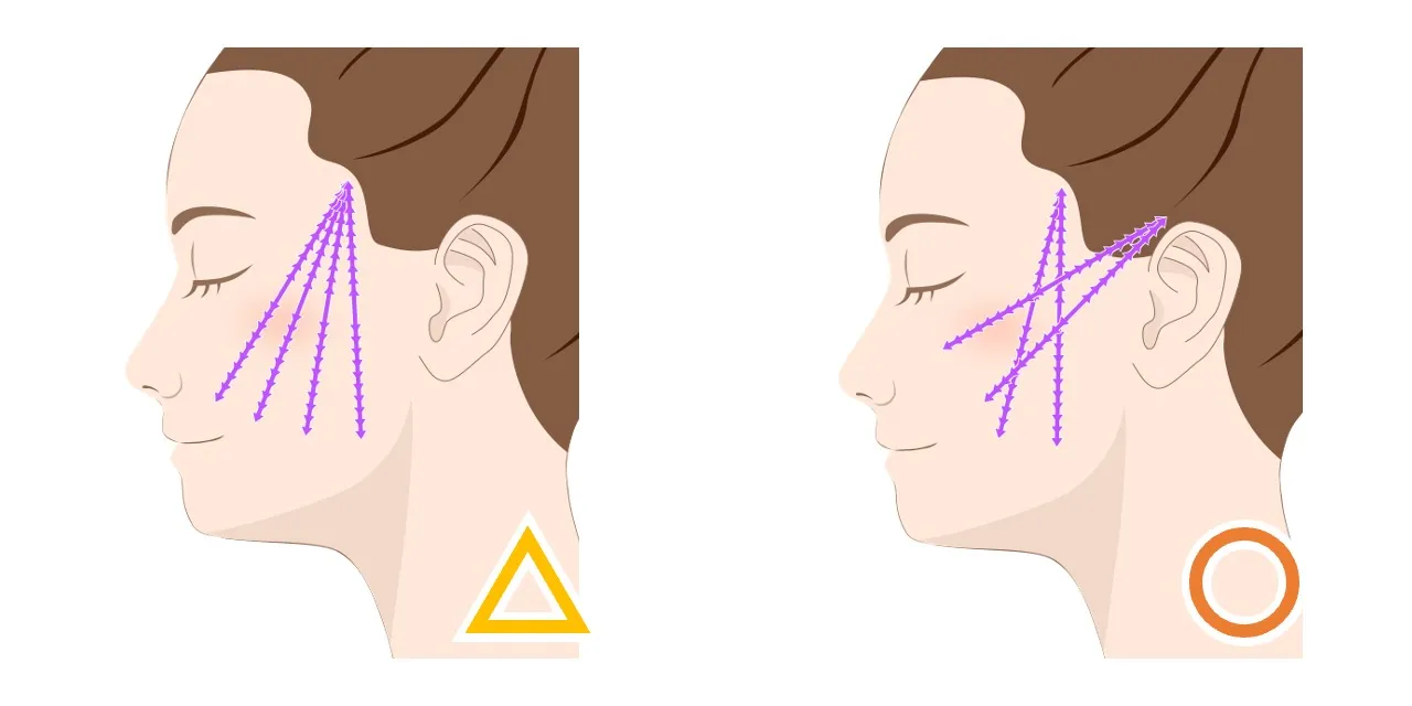 【スレッドリフトは長続きしない？】クリスクロス法で後戻りしにくいスレッドリフト｜オーダーメイドのスレッドリフトならフェイス美容外科 仙台【糸リフト】
