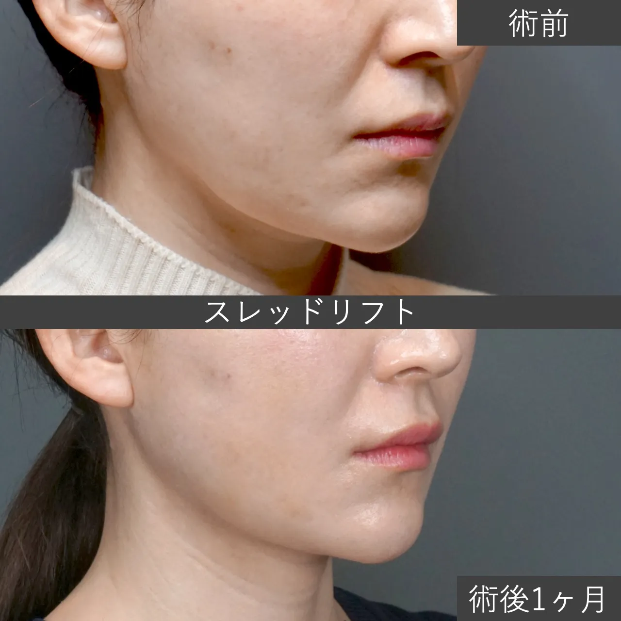 【テスリフト】スレッドリフト(糸リフト)の症例写真 術後1ヶ月|フェイス美容外科 仙台【フェイスリフト】