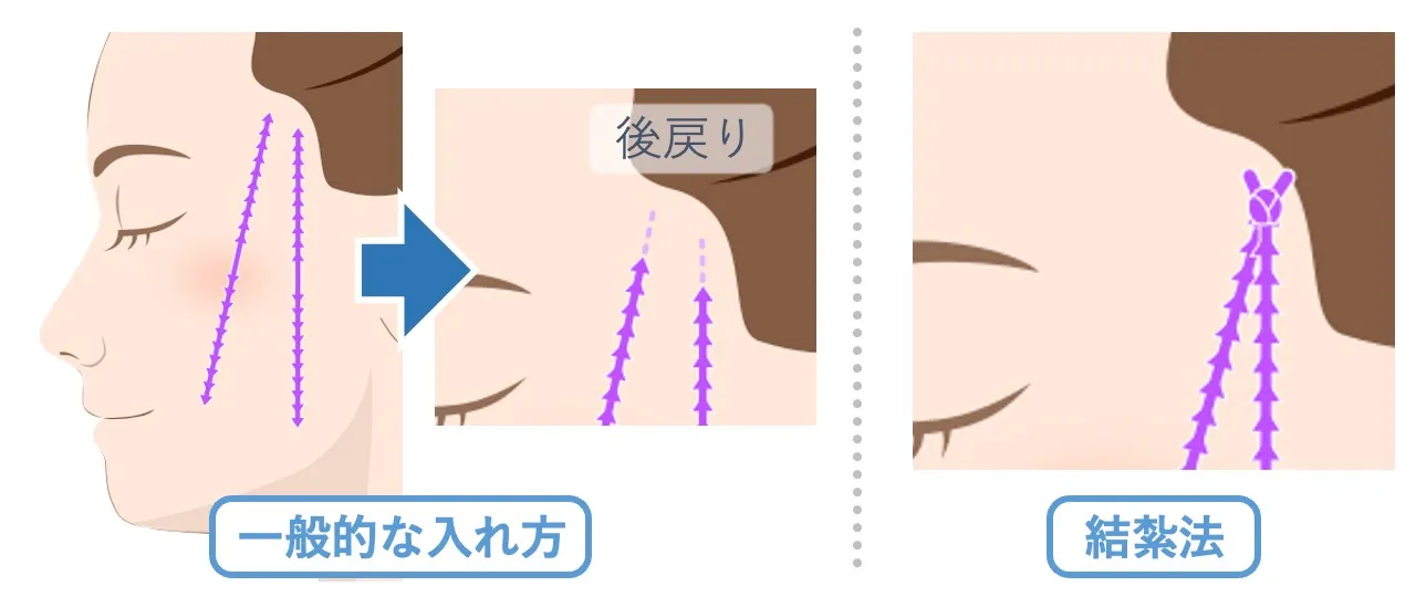 【スレッドリフトは長続きしない？】結紮法：リフトアップ効果と保持力に優れた、後戻りしにくい独自のスレッドリフト｜オーダーメイドのスレッドリフトならフェイス美容外科 仙台【糸リフト】