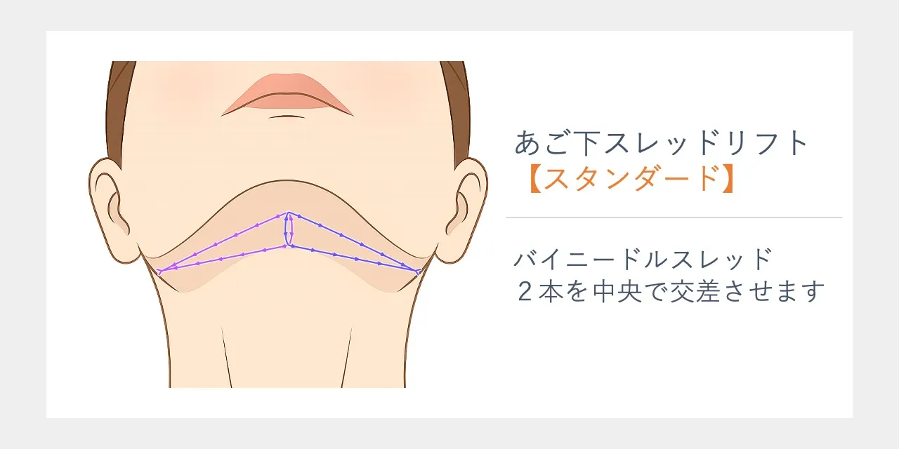 あご下のスレッドリフト【スタンダード】￥154,000｜フェイス美容外科【バイニードル／Bi Needle／アンカーDXダブル】