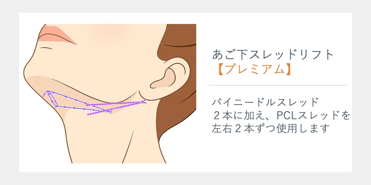 あご下のスレッドリフト【プレミアム】￥220,000｜フェイス美容外科【バイニードル アンカーDXダブル／4Dデュアルクレオパトラ】