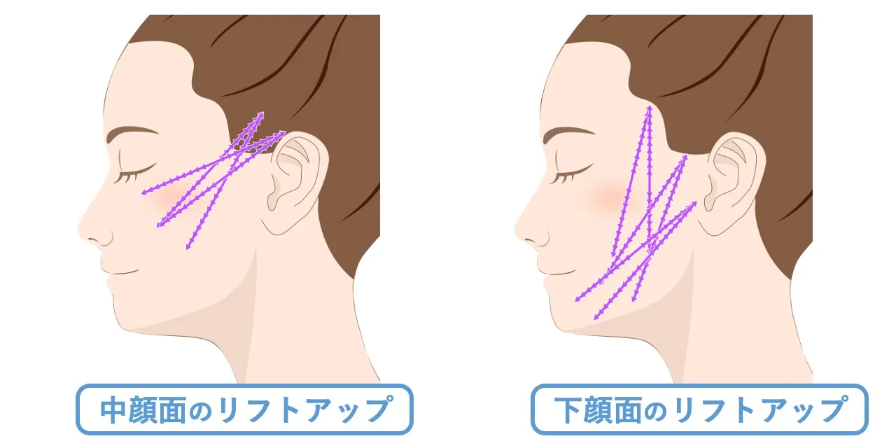 【スレッドリフト】中顔面リフトと下顔面リフト／お悩みにあわせた強力なリフトアップ｜フェイス美容外科 仙台【糸リフト】