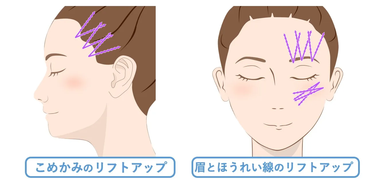 ブローリフト・こめかみリフト・メーラーリフト｜オーダーメイドのスレッドリフトならフェイス美容外科 仙台【糸リフト】