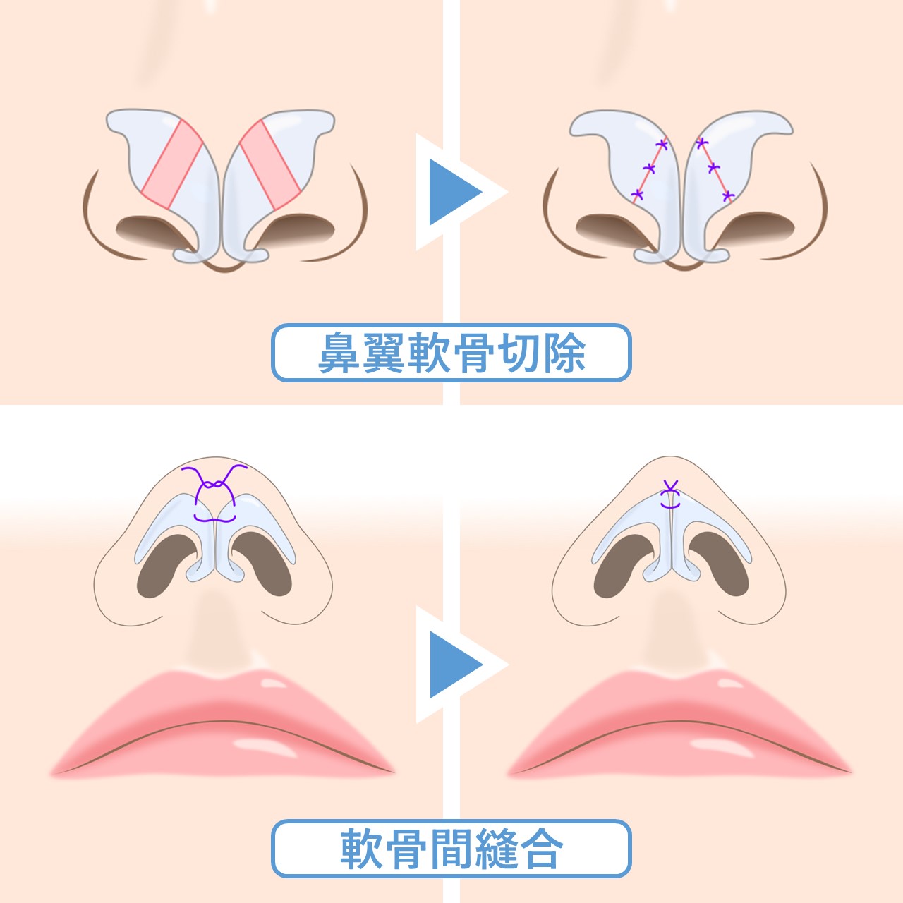 鼻中隔延長術と鼻尖形成、軟骨移植でアップノーズの華やか鼻｜症例写真・ビフォーアフター｜美容整形･美容外科のTAクリニックグループ