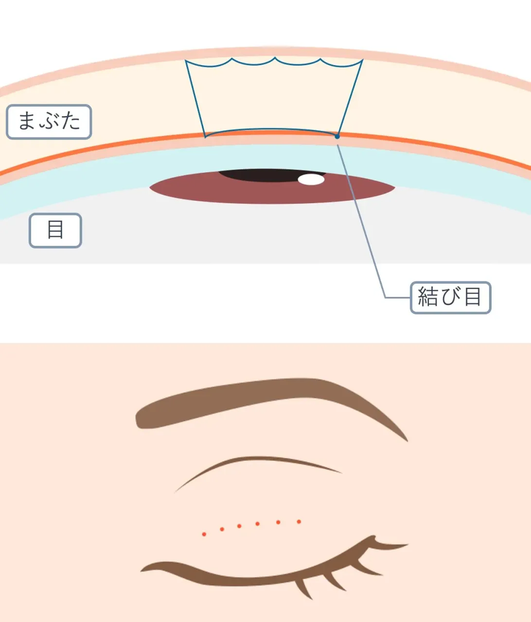 ふたえ埋没<バックループ:裏留めシングルループ>ダウンタイムを抑えたいなら|フェイス美容外科 仙台
