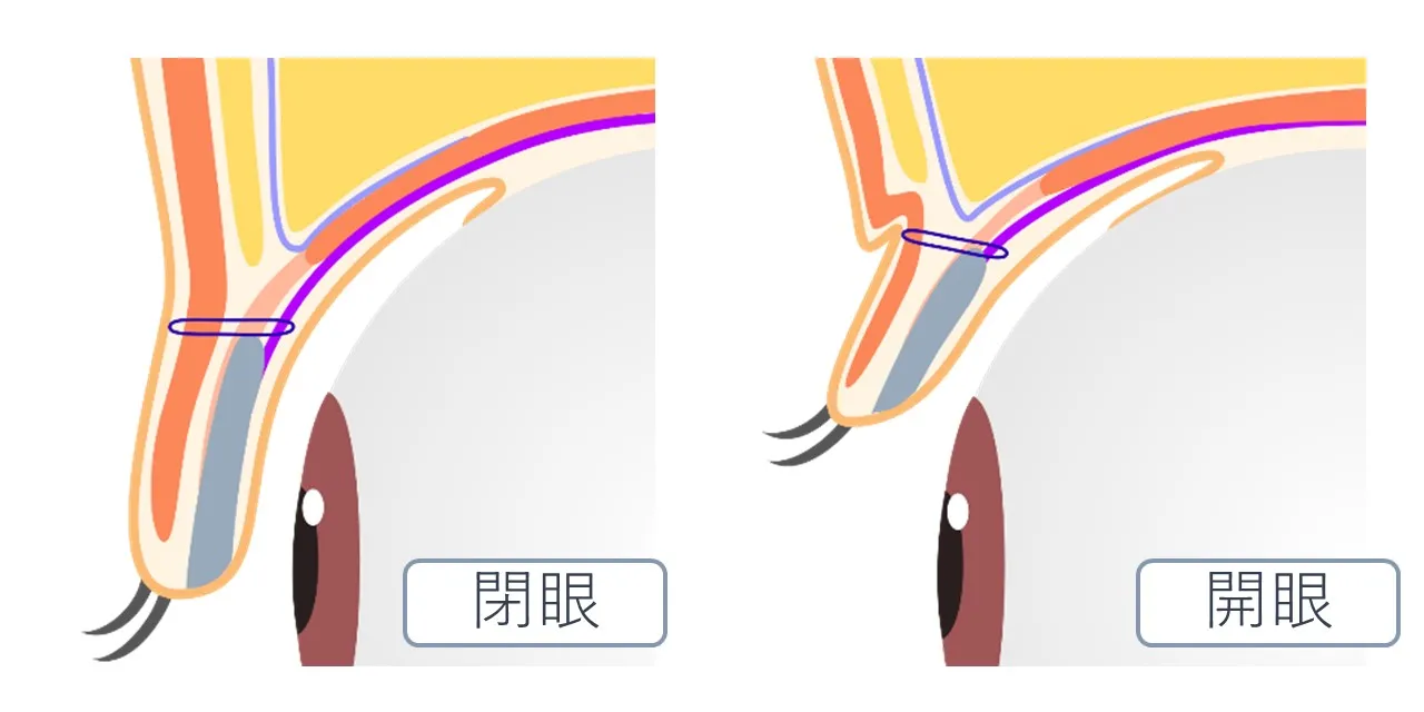 ふたえ切開(二重切開)|切開法と埋没法の違い|フェイス美容外科 仙台