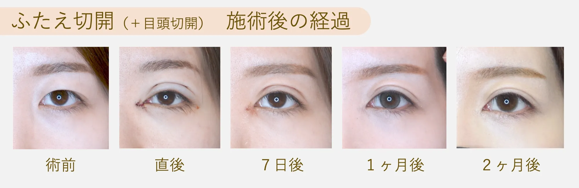 【ダウンタイム】ふたえ切開（全切開）＋目頭切開｜自然な仕上がりで強固な二重整形｜フェイス美容外科 仙台