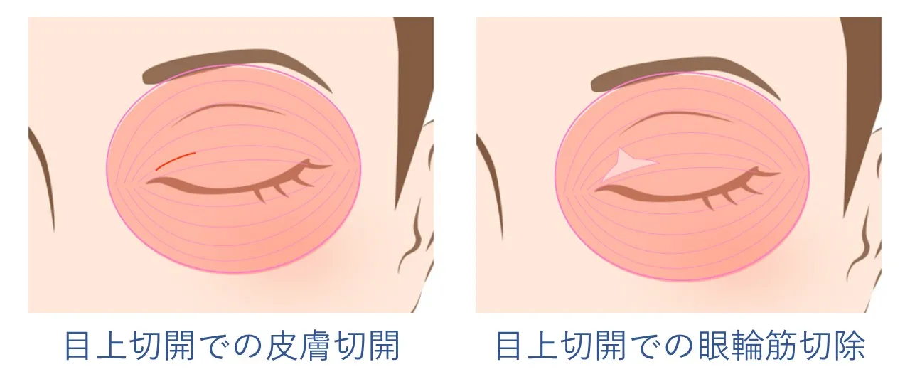 目上切開のメカニズムと切開範囲｜フェイス美容外科 仙台【目頭切開】
