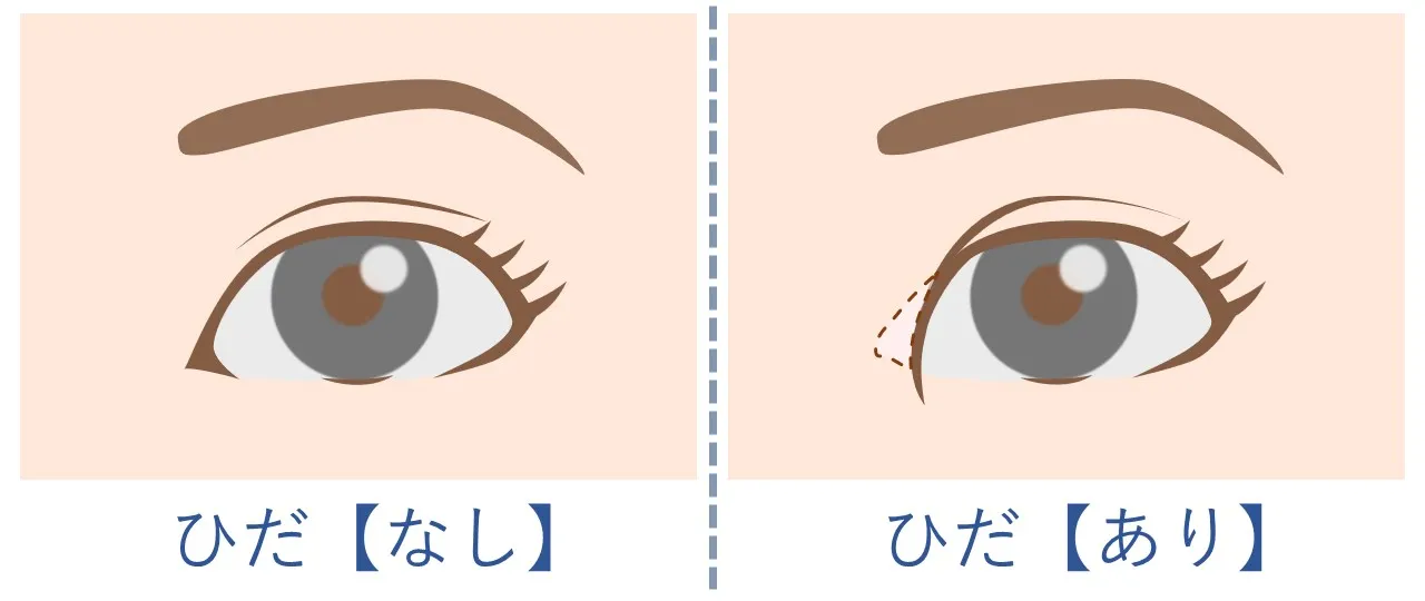 【目頭切開】蒙古ヒダが目頭に及ぼす影響｜フェイス美容外科 仙台