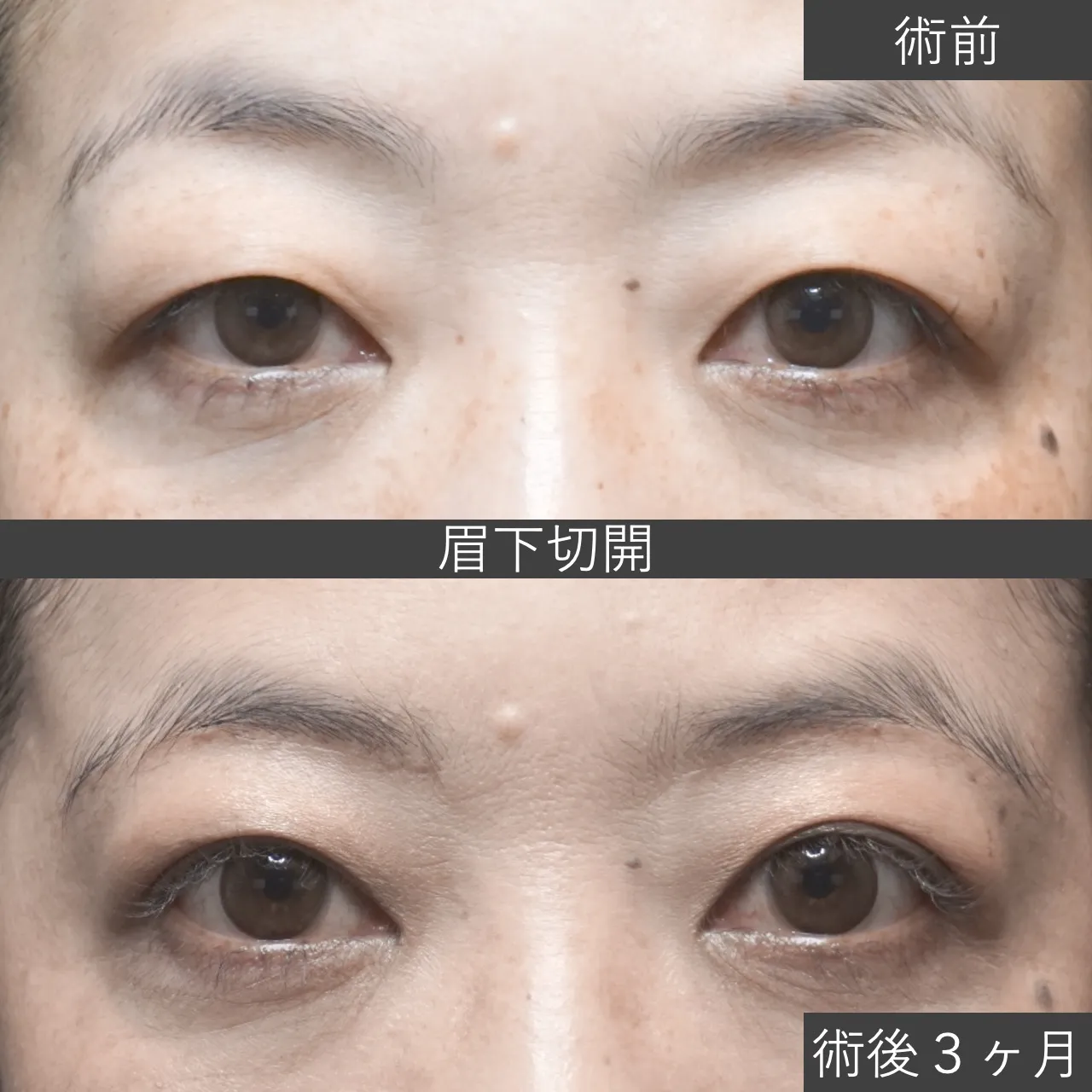 【症例写真】眉下切開（眉下リフト） 術後3ヶ月｜フェイス美容外科 仙台
