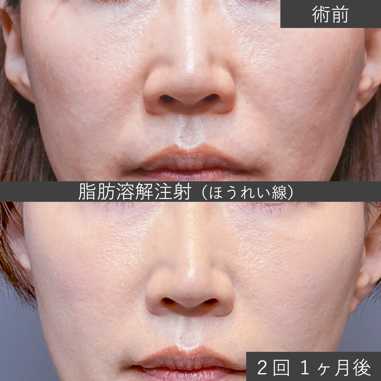 【症例写真・カベリン】ほうれい線(Nasolabial Fat)に対する脂肪溶解注射|フェイス美容外科 仙台