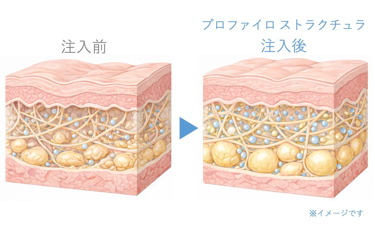 プロファイロ ストラクチュラ 作用のメカニズム｜フェイス美容外科 仙台【頬コケ・フェイスラインのもたつき・ジョールファット】