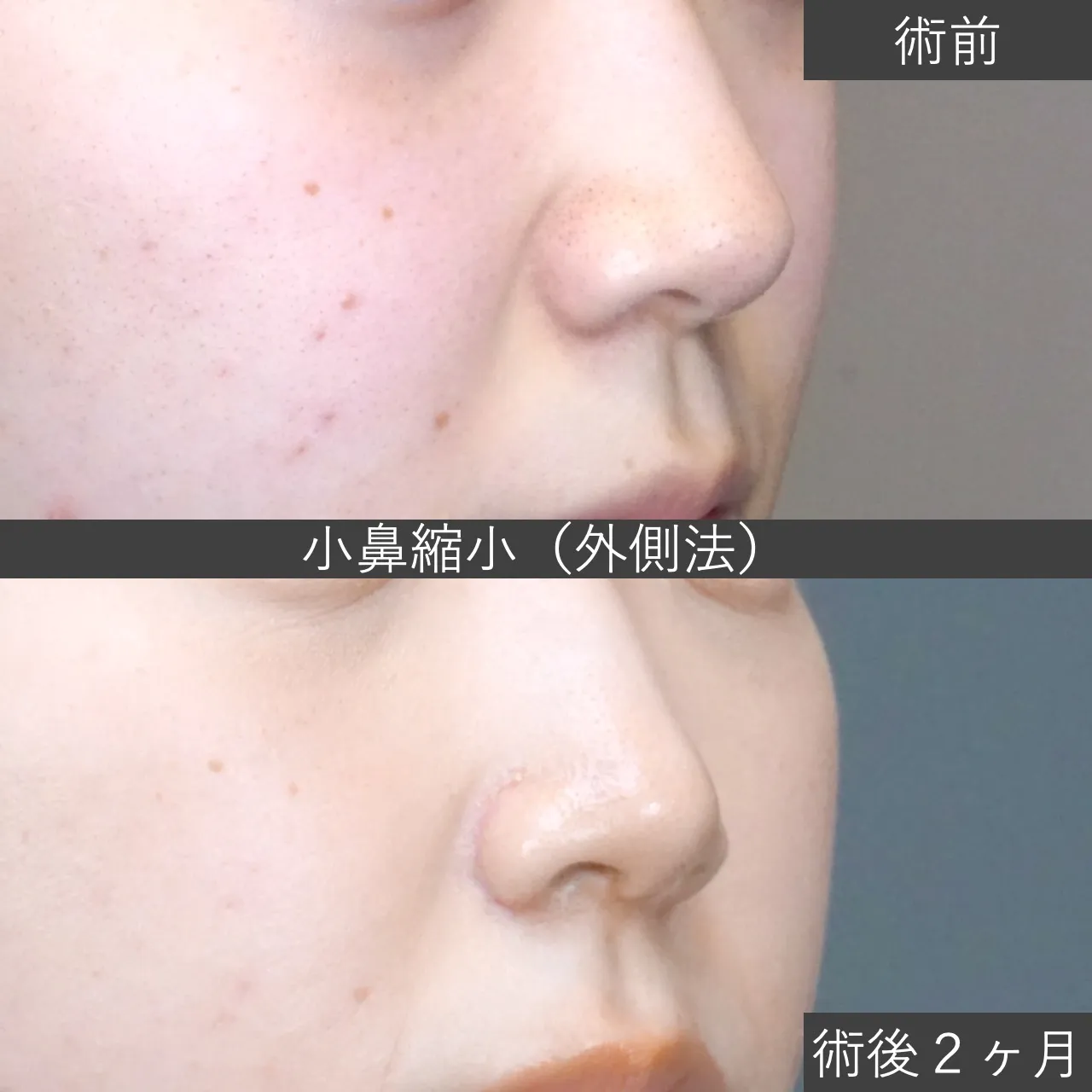 【鼻整形】症例写真 小鼻縮小(外側法) |フェイス美容外科 仙台