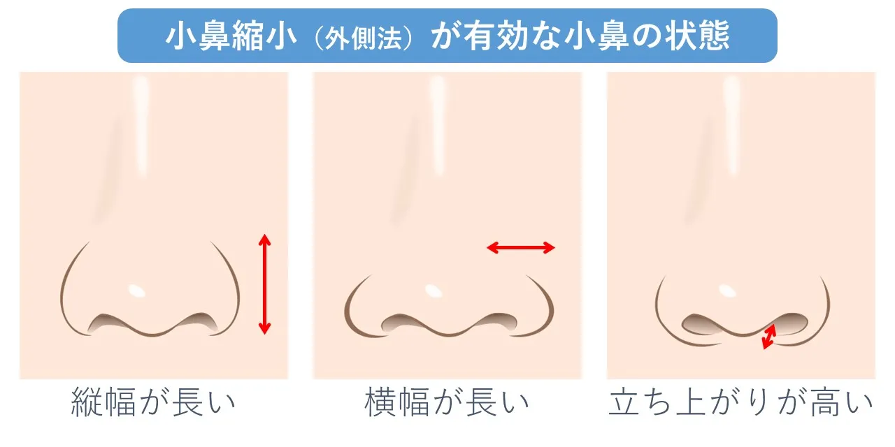 【小鼻縮小】小鼻の印象を決める3つの要素『高さ』『幅』『立ち上がり』｜フェイス美容外科 仙台【鼻整形】