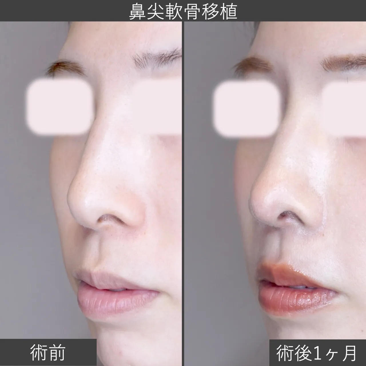 【症例写真：鼻尖軟骨移植】鼻先の形を耳介軟骨の移植で調整｜仙台で鼻整形を受けるならフェイス美容外科