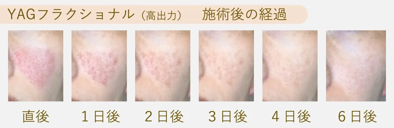 【ダウンタイム】YAGフラクショナル(高めの出力)の施術後経過写真|フェイス美容外科