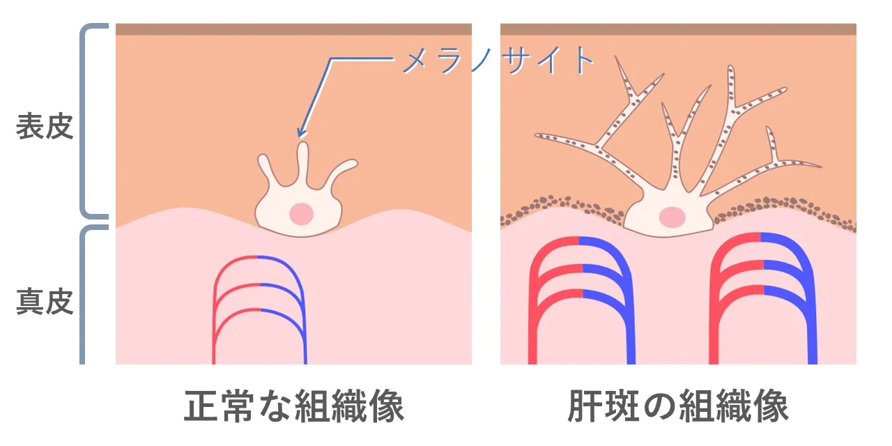 <ブログ:シミと肝斑>肝斑部分で見られる組織の変化|フェイス美容外科 仙台