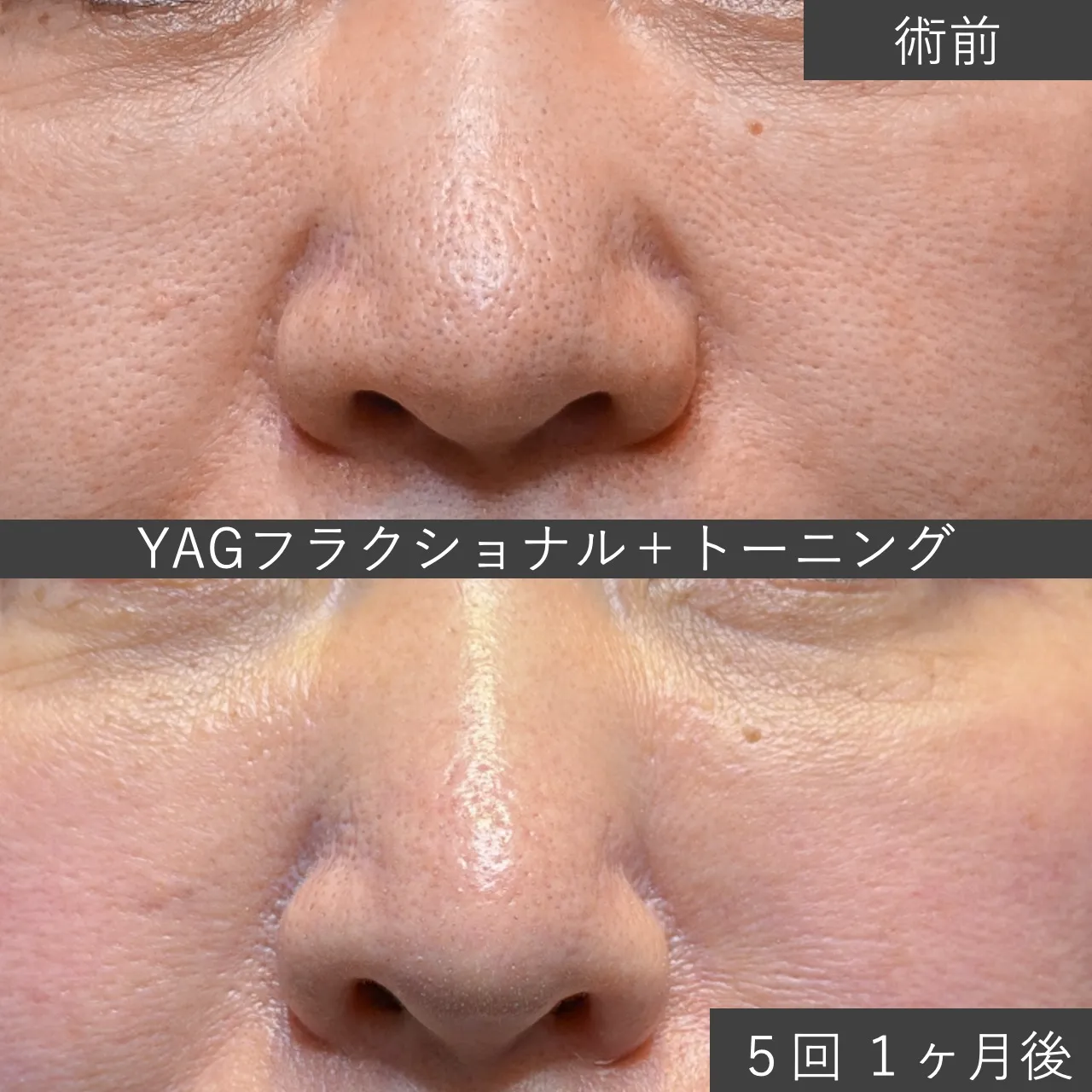【症例写真】鼻の毛穴にYAGフラクショナル＋レーザートーニング｜フェイス美容外科 仙台