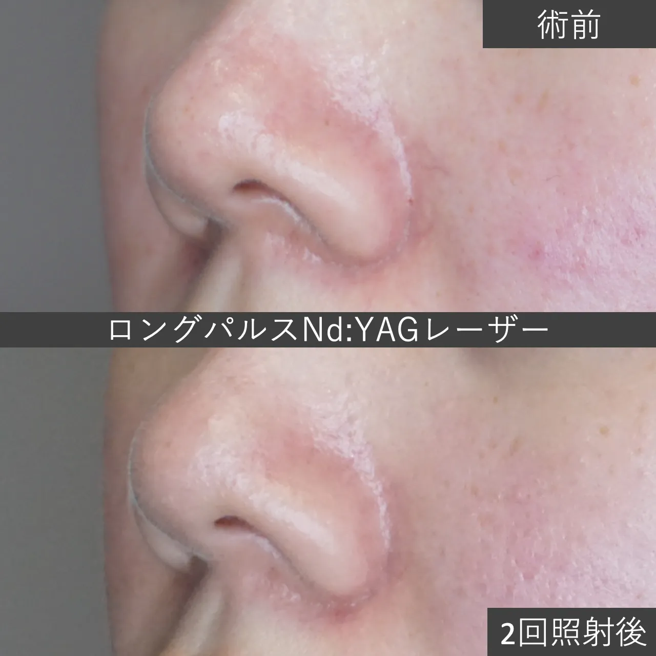 【症例写真】小鼻周りの毛細血管拡張 ロングパルスNd:YAGレーザー｜仙台で老人性血管腫（赤ホクロ）／毛細血管拡張／静脈湖の治療を受けるならフェイス美容外科