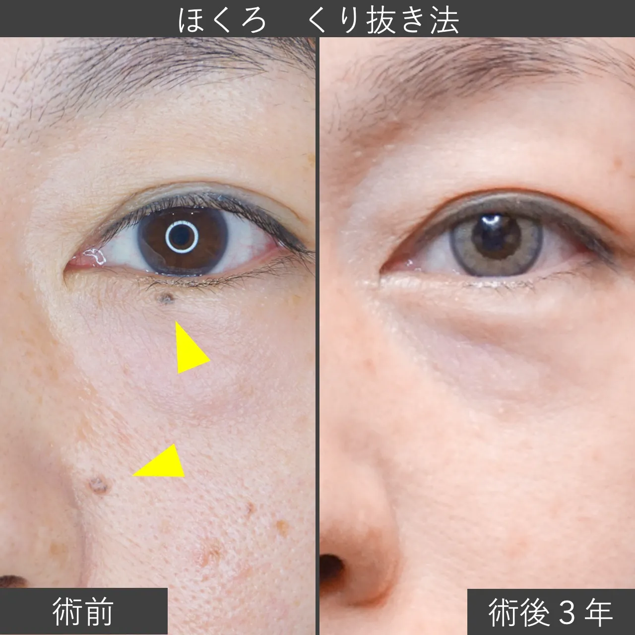 【症例写真】ホクロ除去（くり抜き法）｜フェイス美容外科 仙台