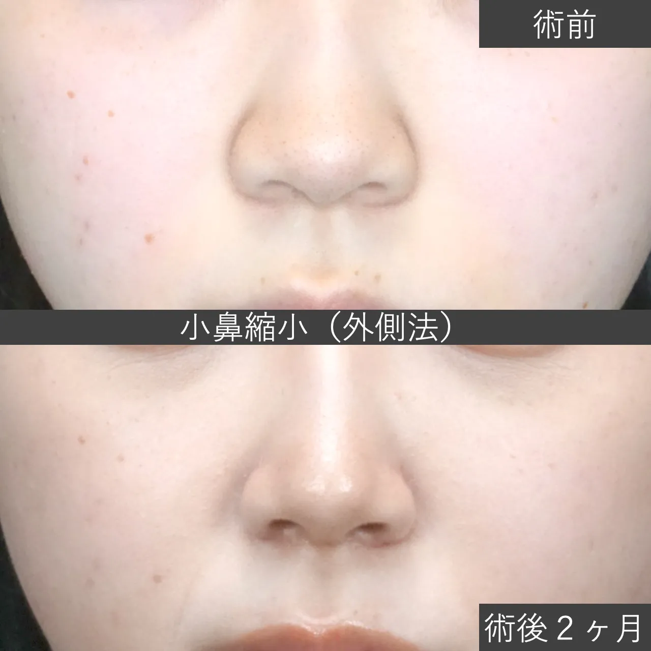 【鼻整形】症例写真　小鼻縮小（外側法）