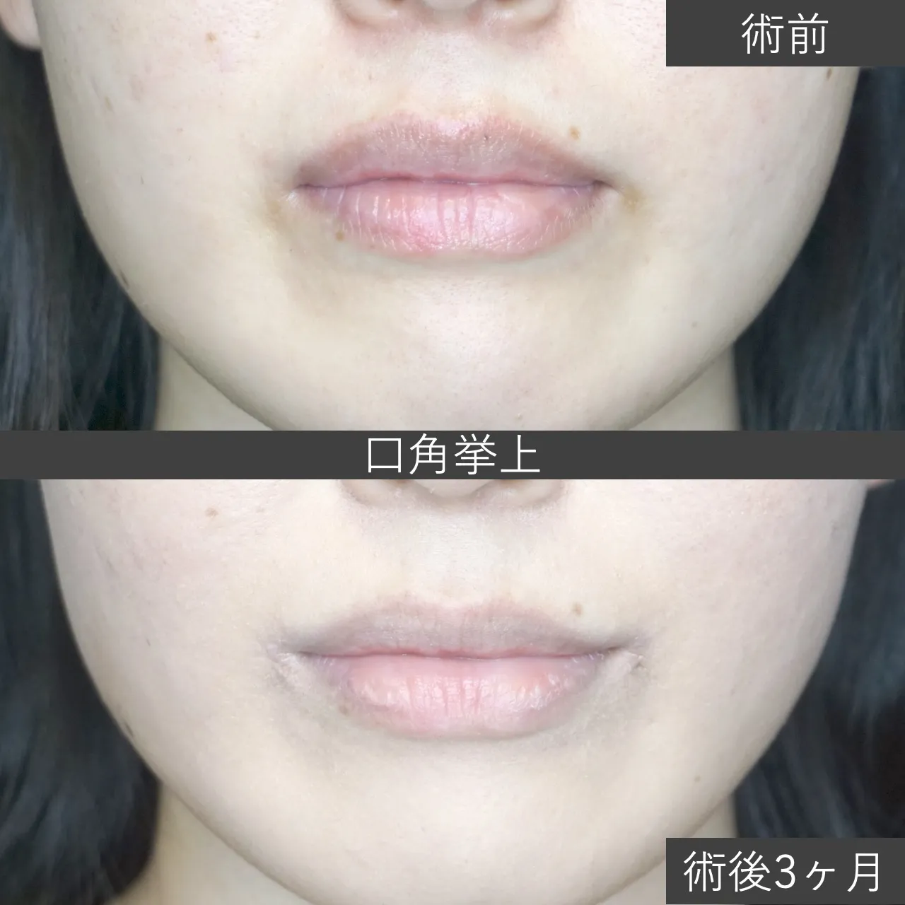 口角挙上　症例写真