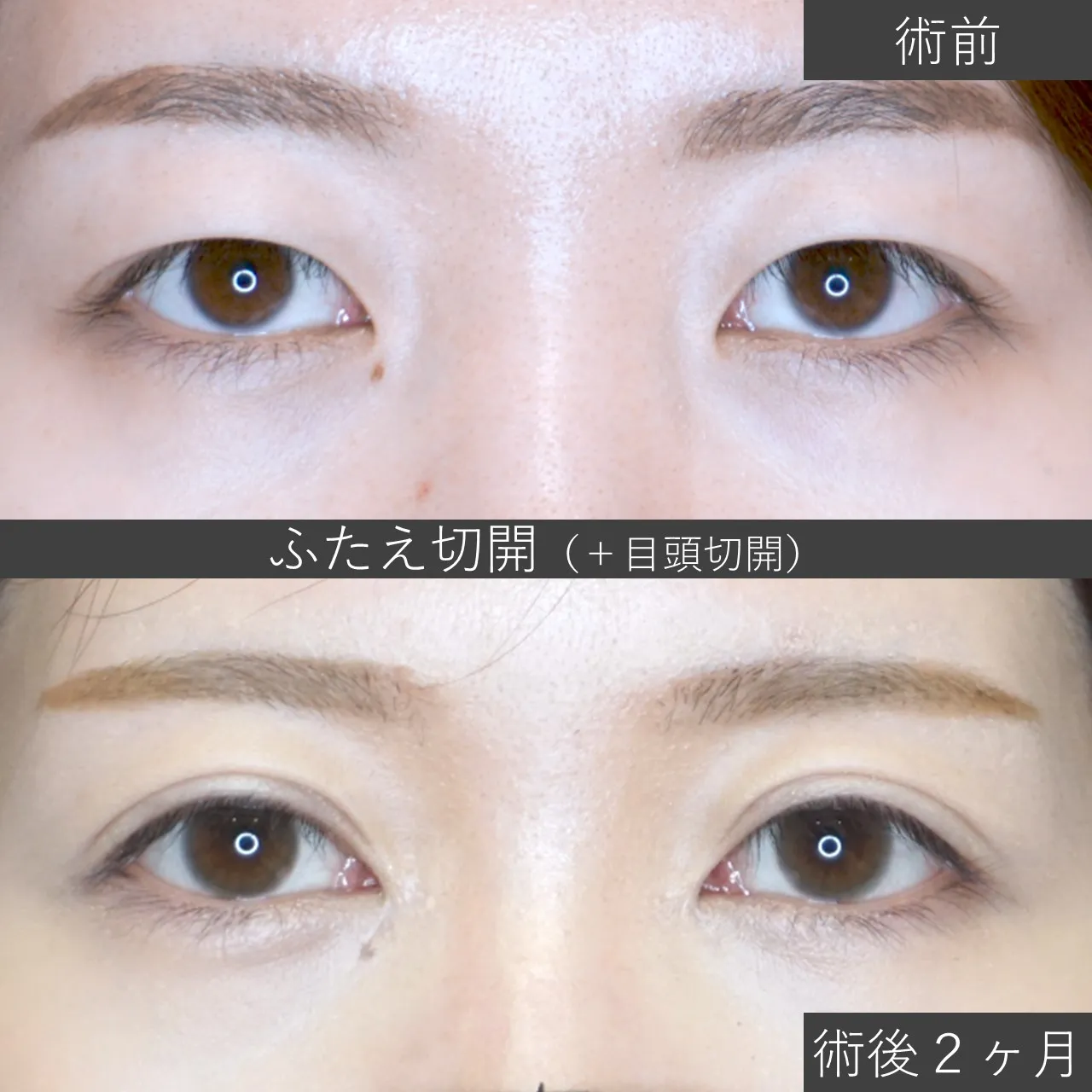 あごプロテーゼの症例写真｜施術前と施術後2ヶ月の目もとの状態