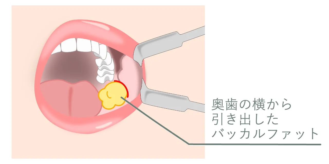 バッカルファット除去術の手術の様子。バッカルファットは奥歯の横の粘膜切開から引き出します。