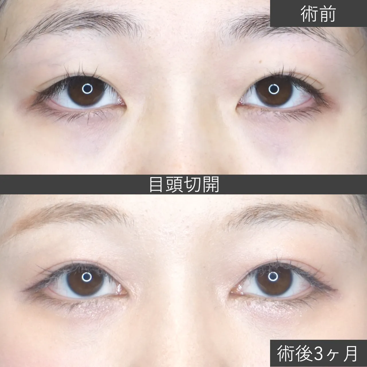 目頭切開 症例写真（術後3ヶ月）