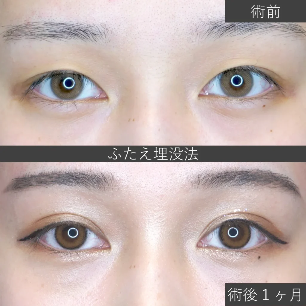二重埋没法の症例写真｜施術前と施術1ヶ月後のまぶたの比較