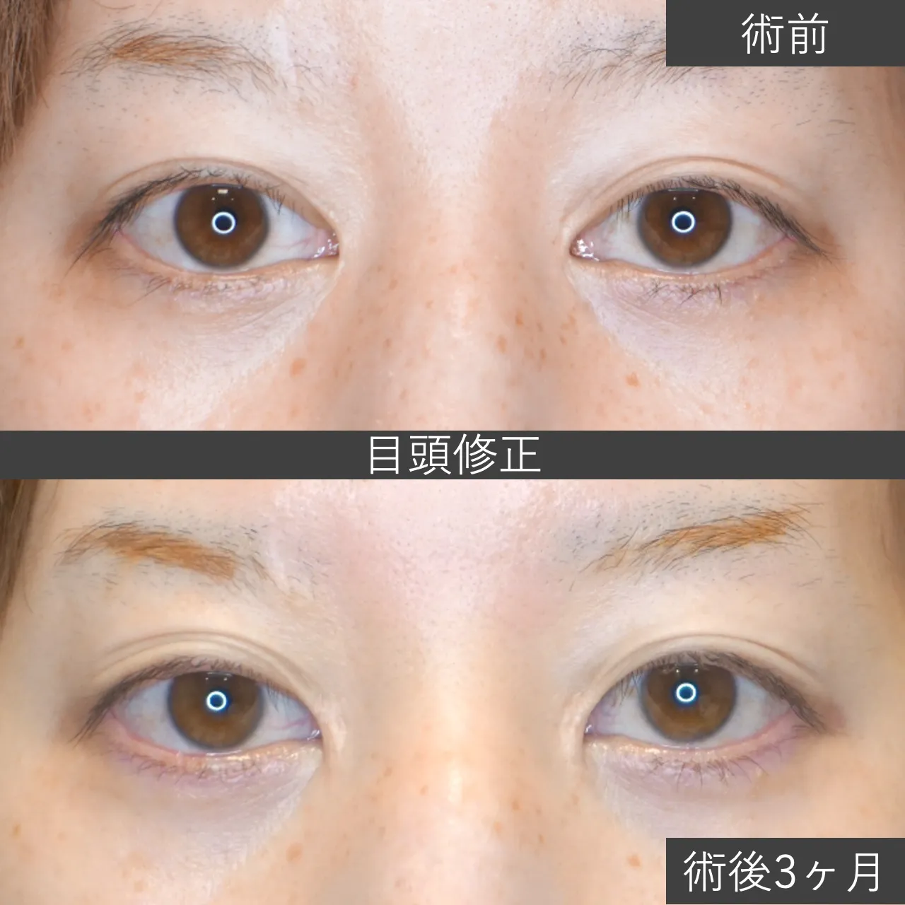 目頭修正　症例写真