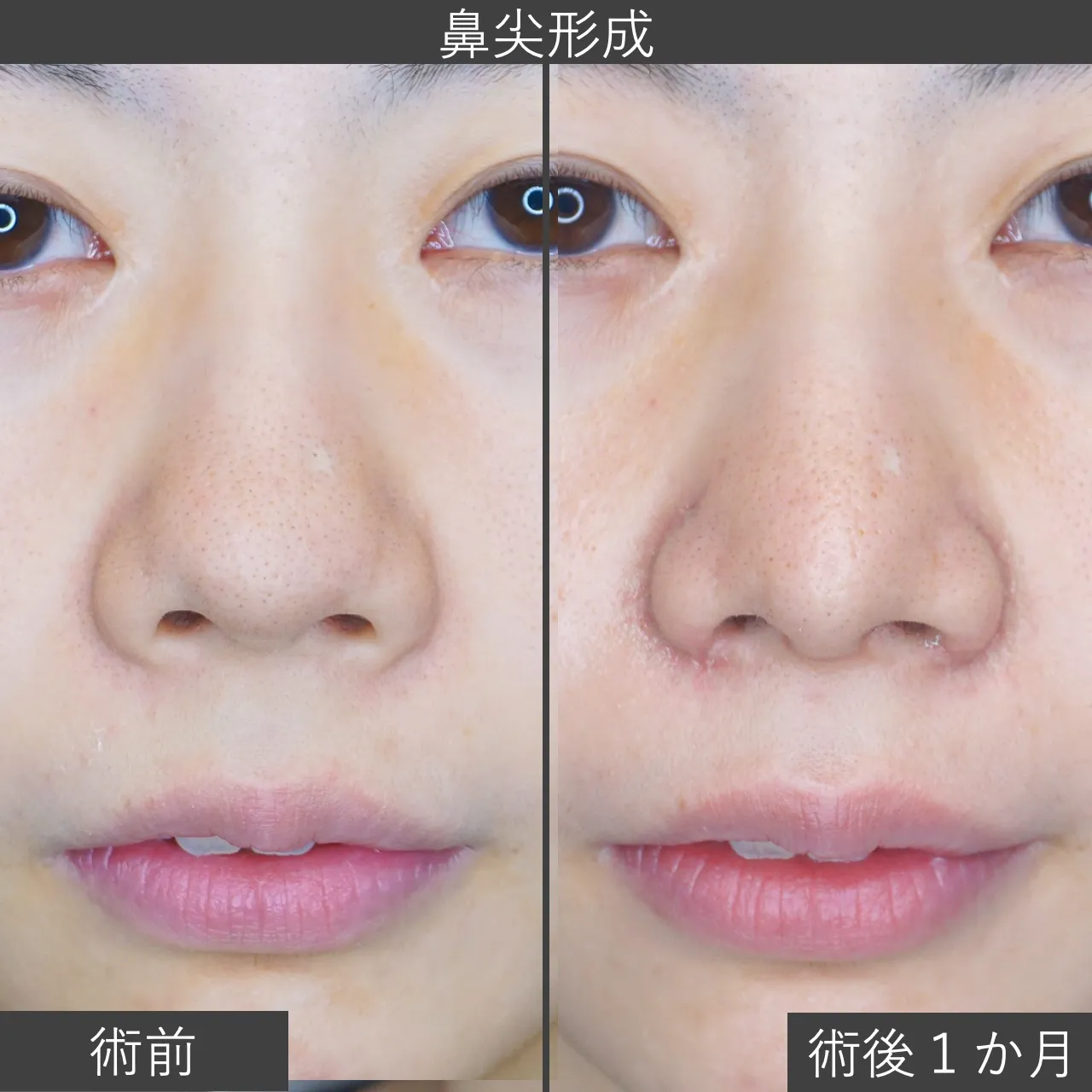 【症例写真：鼻尖形成】鼻先の丸さを整え、シュッとした鼻先に