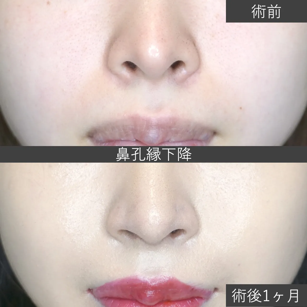 【鼻整形】鼻孔縁下降 症例写真