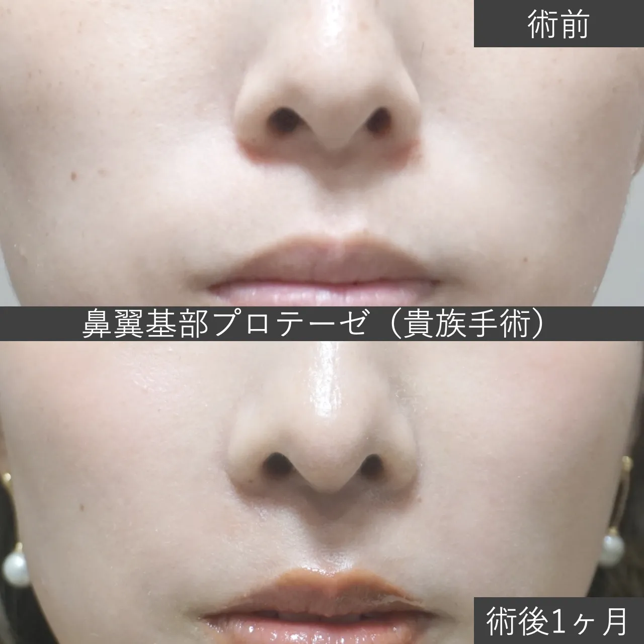 【鼻整形】鼻翼基部プロテーゼ（貴族手術） 症例写真