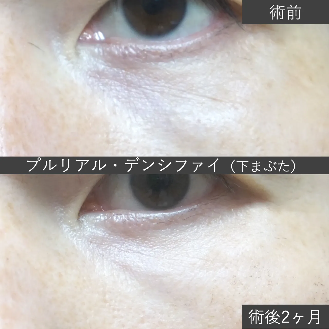 【シワ・乾燥・赤み】肌育治療：プルリアル・デンシファイ 症例写真