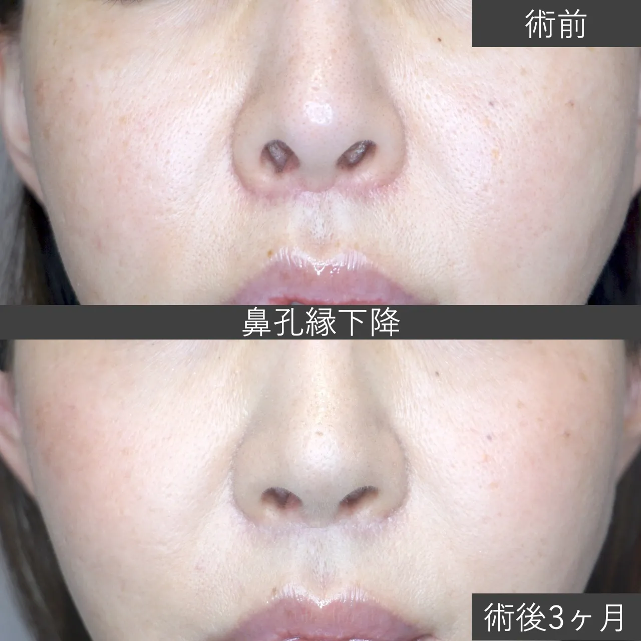 【鼻整形・他院修正】鼻孔縁下降（人中短縮 術後） 症例写真