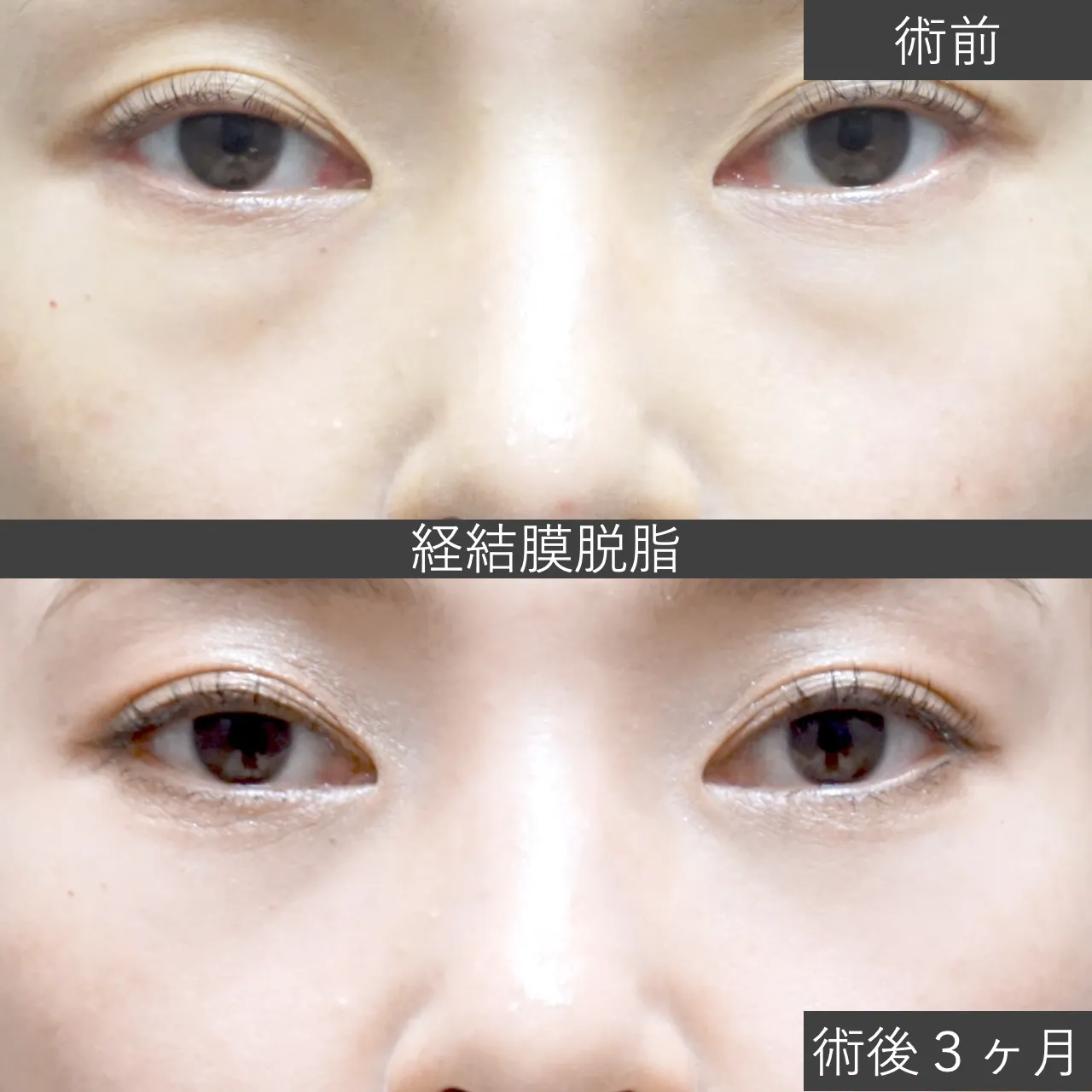 【クマ治療】経結膜脱脂の症例写真｜施術前と施術1ヶ月後の下まぶたの比較