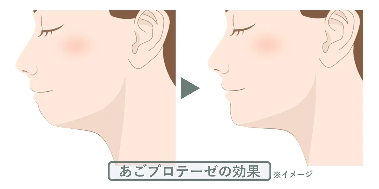 あごプロテーゼで得られる効果・変化