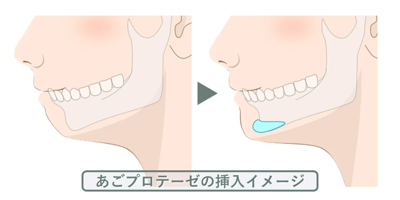 あごプロテーゼ手術におけるプロテーゼの挿入位置のイメージ