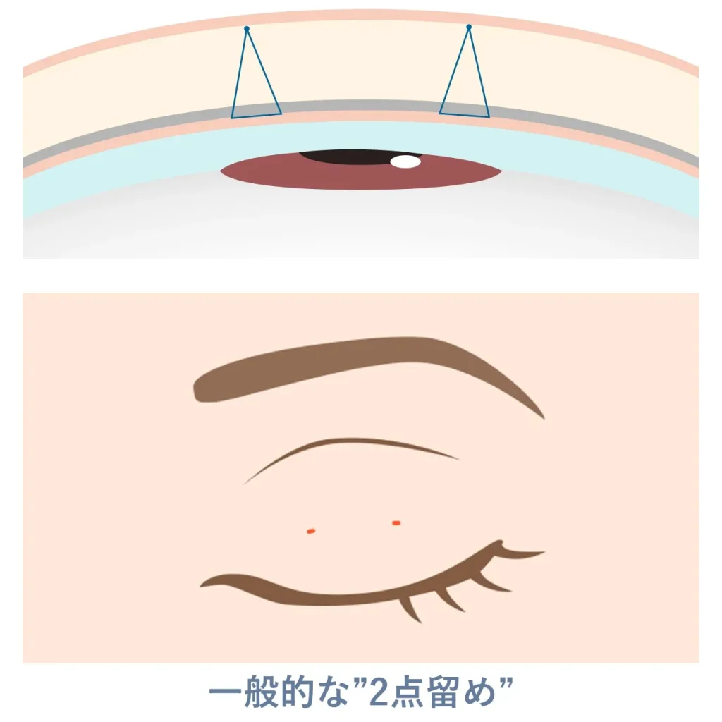 二重埋没法における2点留めのイメージ図
