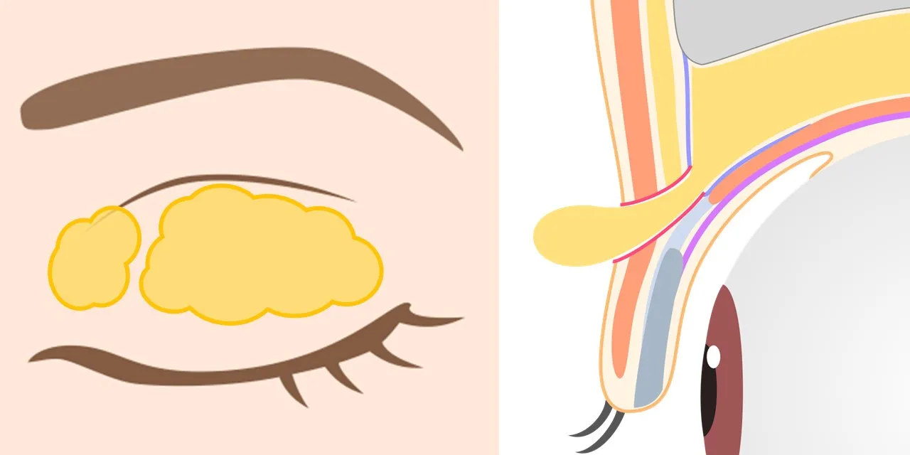 二重埋没法のオプション【上まぶたの脂肪取り】で除去する上眼瞼の眼窩脂肪の位置と、手術イメージ
