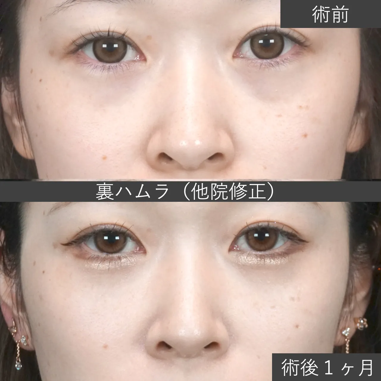 【クマ治療】裏ハムラ（経結膜的眼窩脂肪移動術）による、他院経結膜脱脂後の修正手術｜施術前と施術1ヶ月後の下まぶたの比較