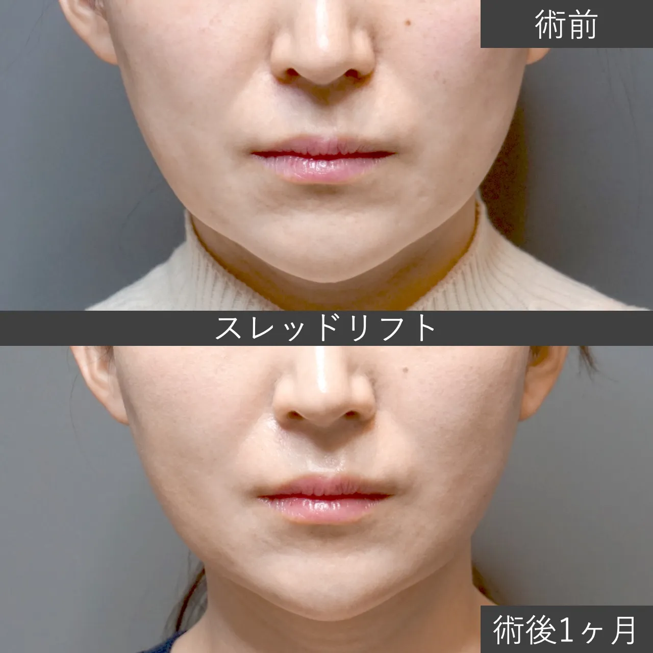 【テスリフト】スレッドリフト（糸リフト）の症例写真 術後1ヶ月