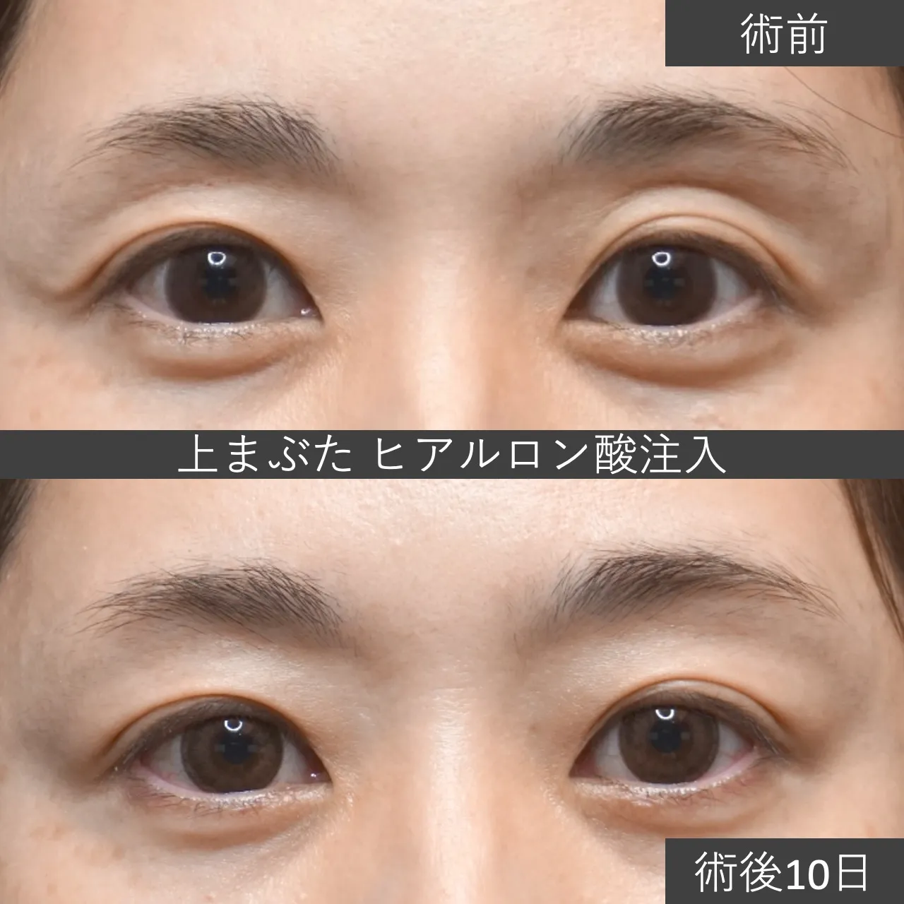 【症例写真】上まぶたのヒアルロン酸注入 術後10日