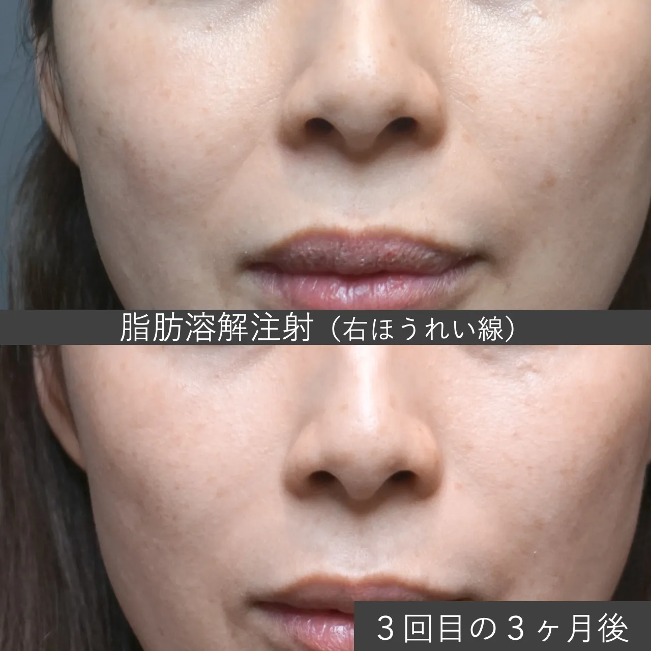 【症例写真・カベリン】ほうれい線（Nasolabial Fat）に対する脂肪溶解注射