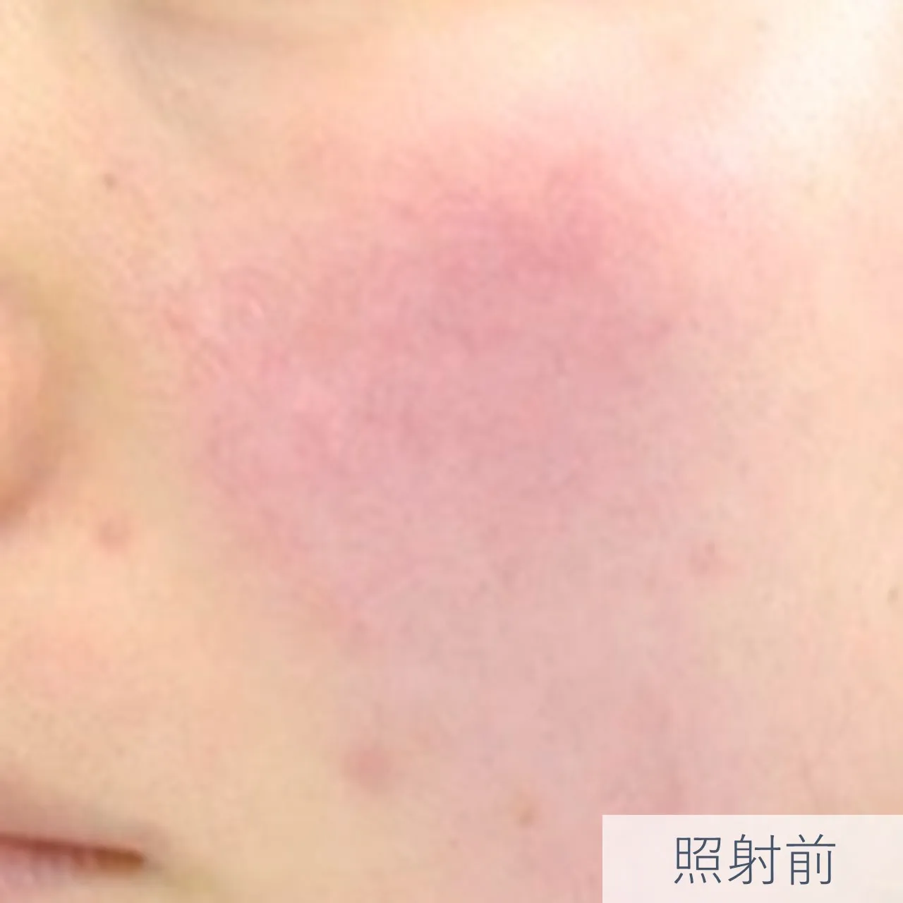 【症例写真】赤ら顔(毛細血管拡張)IPL光治療 Nordlys(ノーリス)照射前