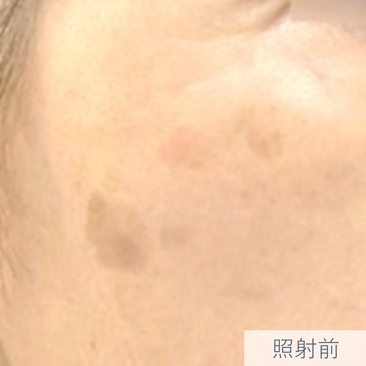 【症例写真】しみ（老人性色素斑）、IPL光治療 Nordlys（ノーリス）照射前