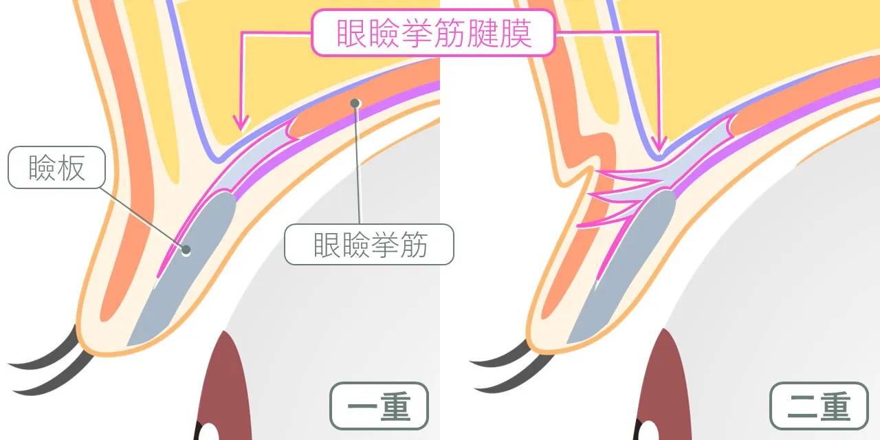 一重まぶたと二重まぶたの内部構造の違い｜挙筋腱膜と皮下の連続性により二重のラインは形成される