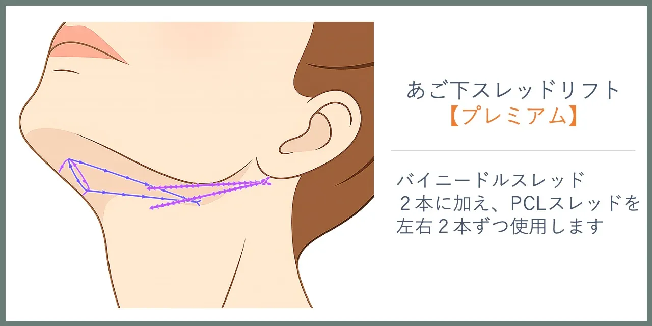 あご下スレッドリフト／バイニードルとPCLを組み合わせた場合の挿入位置