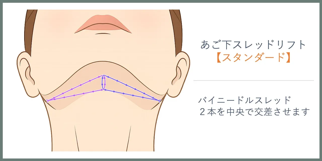 あご下のスレッドリフト【スタンダード】でのスレッドの挿入位置